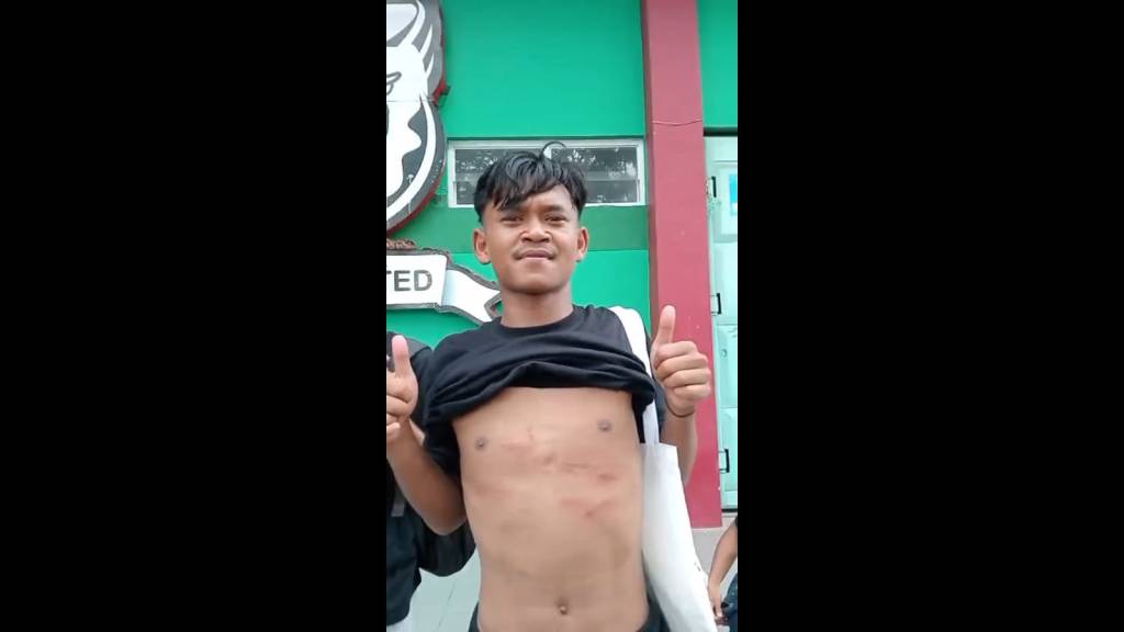 Pemain Perseta 1970 Tulungagung Korban Tendangan Kungfu Alami Retak&nbsp;Tulang